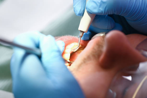 Best Emergency Dental Care for Abscessed Tooth in Hartford, SD